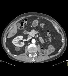 Normal Left Nephrectomy Bed - CTisus CT Scan