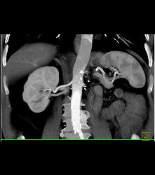 Normal Left Nephrectomy Bed - CTisus CT Scan