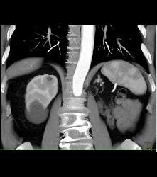 Normal Left Nephrectomy Bed - CTisus CT Scan