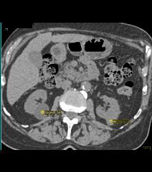 Multiple Renal Cysts Including Several High Density Renal Cysts - CTisus CT Scan