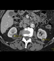 Multiple Renal Cysts Including Several High Density Renal Cysts - CTisus CT Scan