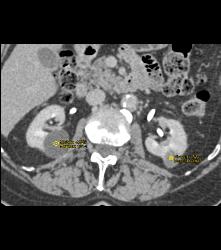 Multiple Renal Cysts Including Several High Density Renal Cysts - CTisus CT Scan