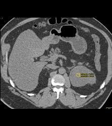 Renal Cysts - CTisus CT Scan