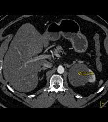 Renal Cysts - CTisus CT Scan