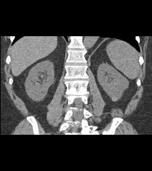 Hypervascular Left Renal Cell Carcinoma - CTisus CT Scan