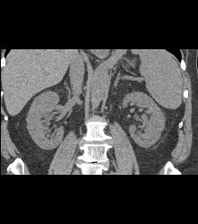 Hypervascular Left Renal Cell Carcinoma - CTisus CT Scan