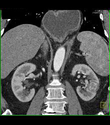 Hypervascular Left Renal Cell Carcinoma - CTisus CT Scan