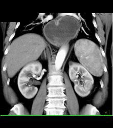 Hypervascular Left Renal Cell Carcinoma - CTisus CT Scan