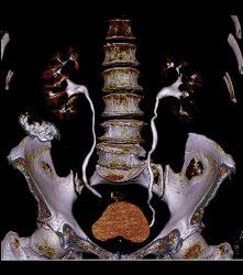 Hypervascular Left Renal Cell Carcinoma - CTisus CT Scan