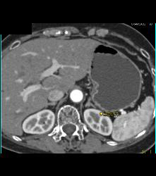 Normal Corticomedullary Phase - CTisus CT Scan