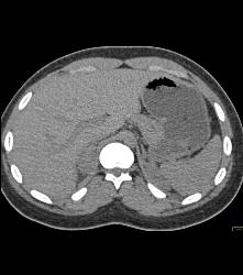 Right Adrenal Hematoma and Pyelonephritis in Right Kidney - CTisus CT Scan