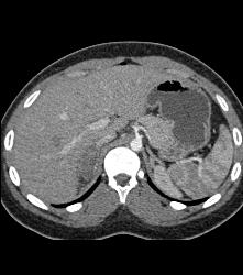 Right Adrenal Hematoma and Pyelonephritis in Right Kidney - CTisus CT Scan