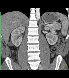 Right Adrenal Hematoma and Pyelonephritis in Right Kidney - CTisus CT Scan