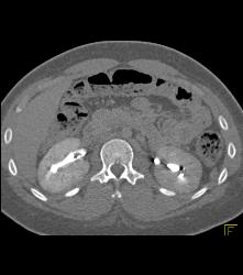 Blood Clots in the Right Renal Pelvis - CTisus CT Scan