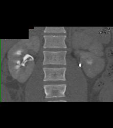 Blood Clots in the Right Renal Pelvis - CTisus CT Scan