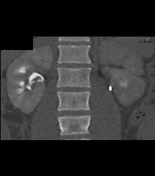 Blood Clots in the Right Renal Pelvis - CTisus CT Scan