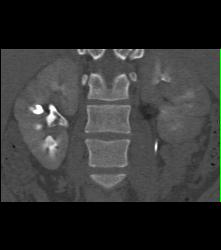 Blood Clots in the Right Renal Pelvis - CTisus CT Scan