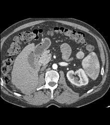 Normal Right Nephrectomy Bed - CTisus CT Scan