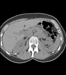 Hypovascular Right Renal Cell Carcinoma - CTisus CT Scan