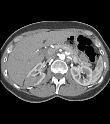 Hypovascular Right Renal Cell Carcinoma - CTisus CT Scan