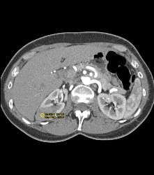 Hypovascular Right Renal Cell Carcinoma - CTisus CT Scan