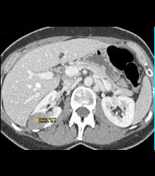 Hypovascular Right Renal Cell Carcinoma - CTisus CT Scan