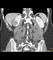 Hypovascular Right Renal Cell Carcinoma - CTisus CT Scan