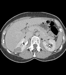 Hypovascular Right Renal Cell Carcinoma - CTisus CT Scan