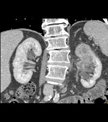 Transitional Cell Carcinoma of the Left Kidney -see Figure Sequence - CTisus CT Scan