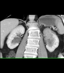 Transitional Cell Carcinoma of the Left Kidney -see Figure Sequence - CTisus CT Scan