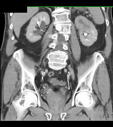 Transitional Cell Carcinoma of the Left Kidney -see Figure Sequence - CTisus CT Scan