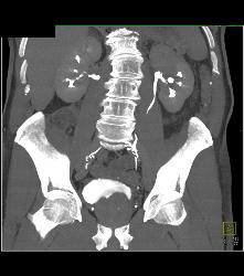 Transitional Cell Carcinoma of the Left Kidney -see Figure Sequence - CTisus CT Scan