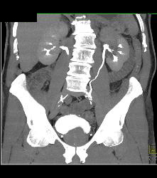 Transitional Cell Carcinoma of the Left Kidney -see Figure Sequence - CTisus CT Scan