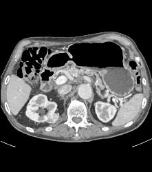 Right Renal Cell Carcinoma - CTisus CT Scan