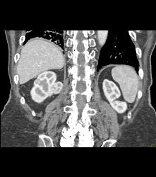 Right Renal Cell Carcinoma - CTisus CT Scan