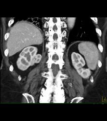 Right Renal Cell Carcinoma - CTisus CT Scan