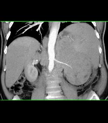 Left Renal Cell Carcinoma - CTisus CT Scan