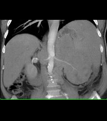 Left Renal Cell Carcinoma - CTisus CT Scan