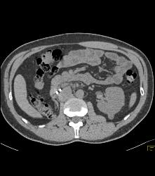 Recurrent Right Renal Cell Carcinoma With Adenopathy -see Full Sequence - CTisus CT Scan