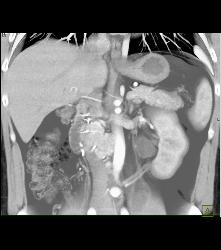 Recurrent Right Renal Cell Carcinoma With Adenopathy -see Full Sequence - CTisus CT Scan