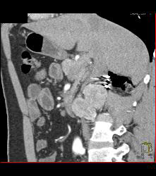 Recurrent Right Renal Cell Carcinoma With Adenopathy -see Full Sequence - CTisus CT Scan