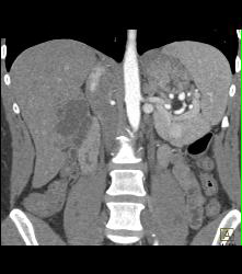 Recurrent Right Renal Cell Carcinoma With Adenopathy -see Full Sequence - CTisus CT Scan