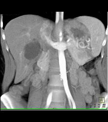 Recurrent Right Renal Cell Carcinoma With Adenopathy -see Full Sequence - CTisus CT Scan