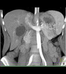 Recurrent Right Renal Cell Carcinoma With Adenopathy -see Full Sequence - CTisus CT Scan