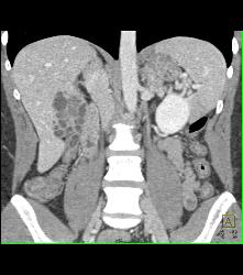 Recurrent Necrotic Tumor in Right Renal Bed - CTisus CT Scan