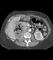 Recurrent Necrotic Tumor in Right Renal Bed - CTisus CT Scan