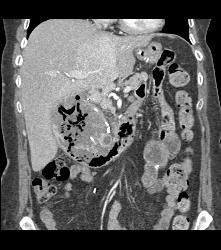 Recurrent Necrotic Tumor in Right Renal Bed - CTisus CT Scan