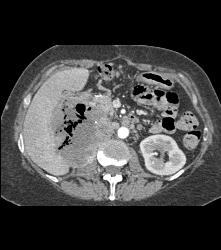 Recurrent Necrotic Tumor in Right Renal Bed - CTisus CT Scan