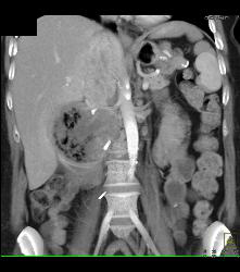 Recurrent Necrotic Tumor in Right Renal Bed - CTisus CT Scan