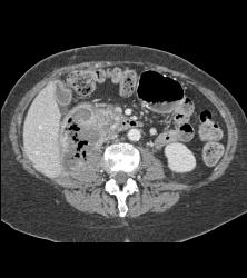 Recurrent Necrotic Tumor in Right Renal Bed - CTisus CT Scan